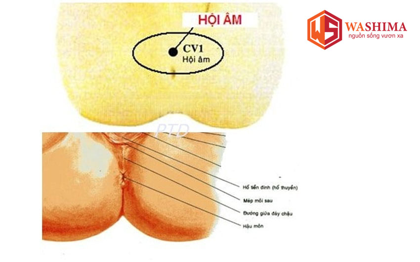 Cách châm cứu huyệt hội âm Cách châm cứu huyệt hội âm
